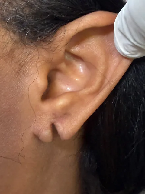 Lóbulo de orelha rasgado, com fenda visível, antes da reparação