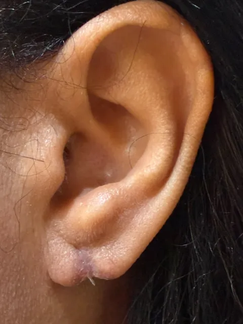 Lóbulo logo após a reparação sem corte, com o contorno refeito