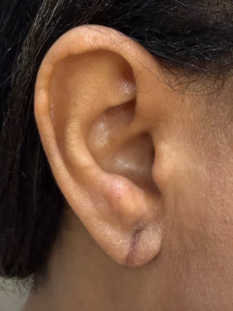Lóbulo em cicatrização, com linha fina no lugar da fenda